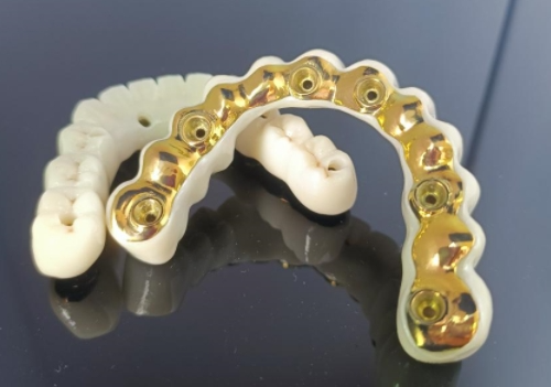 CAD/CAM แท่งเทียมไทเทเนียม + สะพานเซอร์โคเนีย