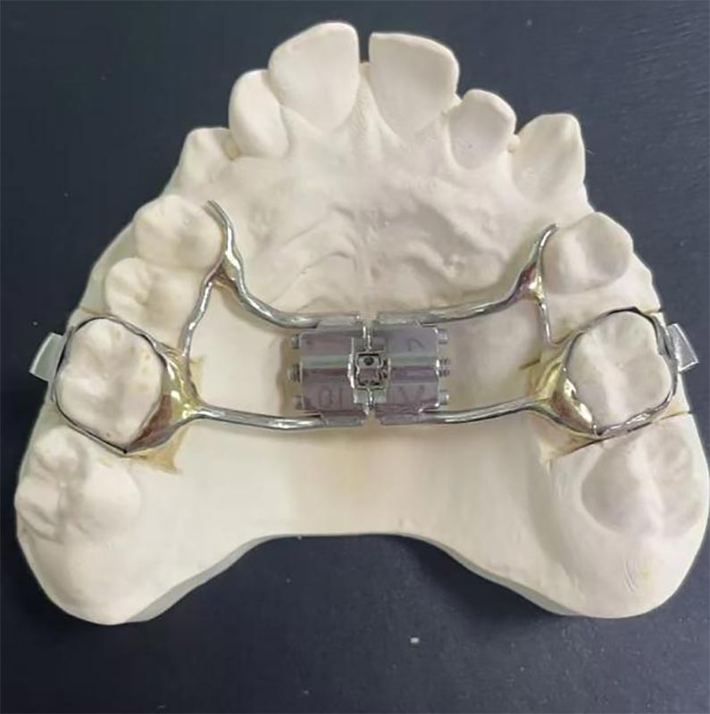 Expander Maxillary อย่างรวดเร็ว (RME) คืออะไร?
