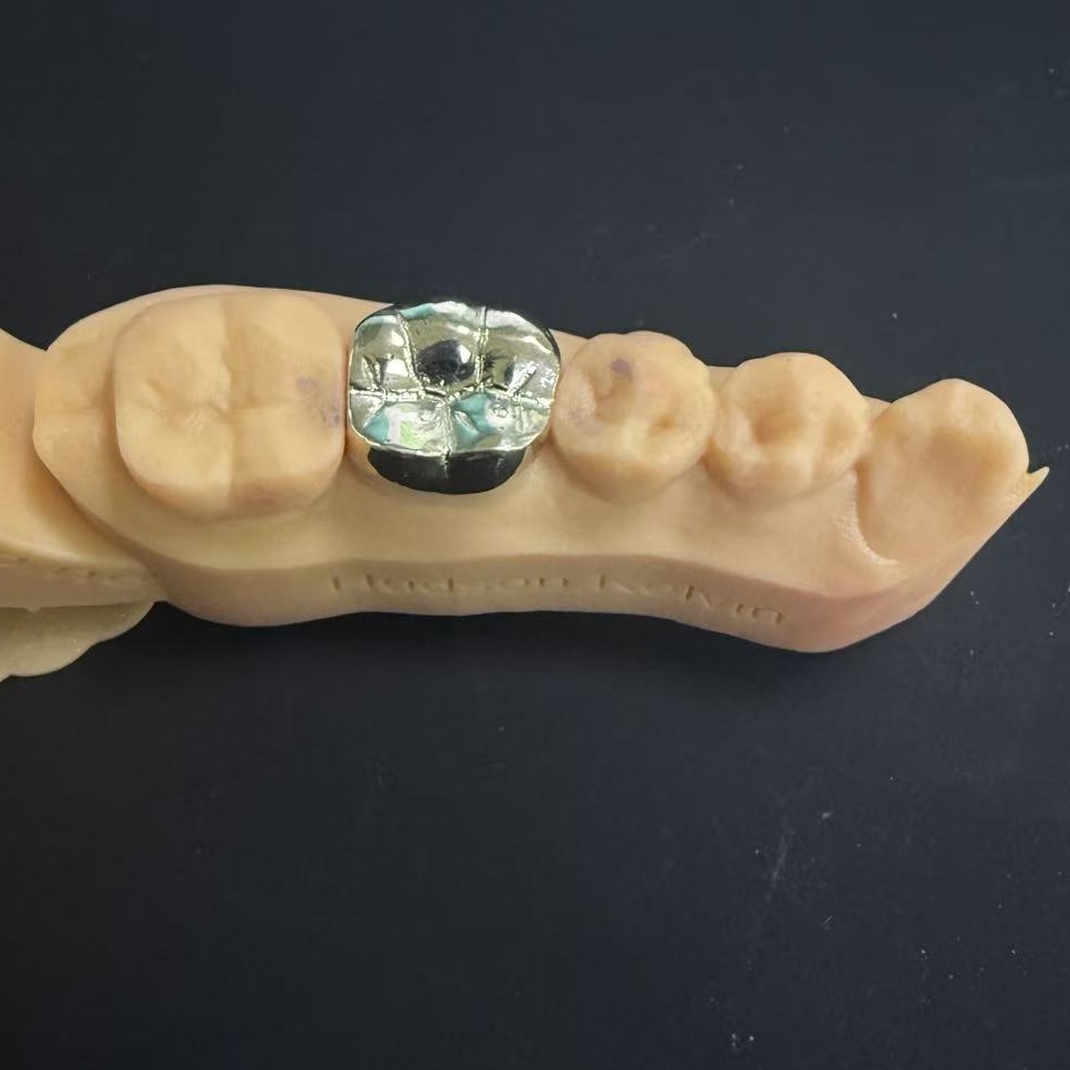 ครอบฟันทองคำ: ตัวเลือกโลหะล้ำค่าสำหรับการบูรณะฟันตลอดชีวิต