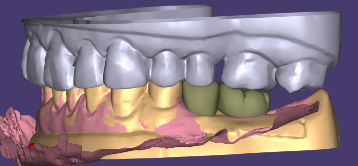 WM Dental Lab's Aesthetic Wax-Up and Provisional Restoration Wins unnimous customer เสียงไชโยโห่ร้องเป็นเอกฉันท์
