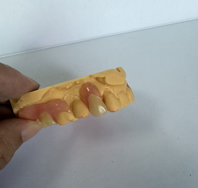 การทำ Valplast Partial ที่ WM Dental Lab
