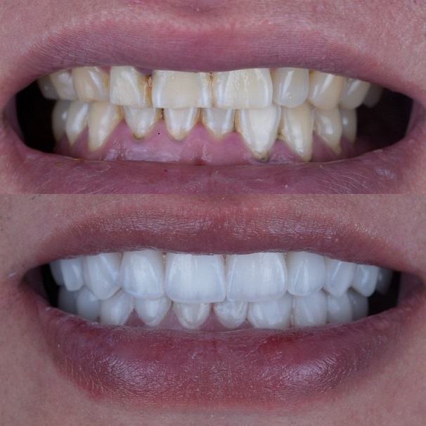 Emax Layered Veneers Esthetic งานห้องปฏิบัติการทันตกรรมจีน