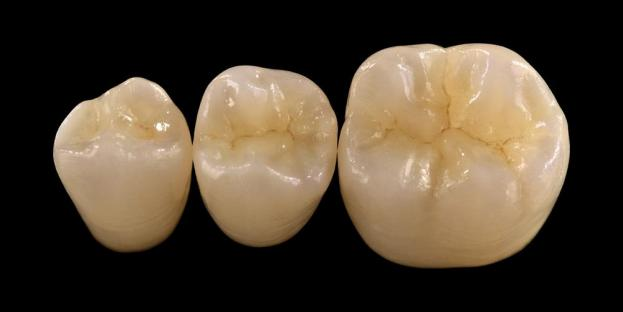 <h2>เซอร์โคเนียในทางทันตกรรม: ข้อบ่งชี้ ข้อดี และข้อควรพิจารณาทางคลินิก</h2>
<p>เซอร์โคเนียได้รับการยอมรับอย่างกว้างขวางถึงความแข็งแกร่งและความทนทาน วัสดุเซอร์โคเนียรุ่นล่าสุดยังมีคุณสมบัติด้านสุนทรียศาสตร์ที่ได้รับการปรับปรุงให้ดีขึ้นอย่างมาก สำหรับผู้ป่วยที่พิจารณาการบูรณะฟันด้วยเซรามิกทั้งหมด จำเป็นต้องประเมินทั้งข้อบ่งชี้และข้อจำกัดของระบบที่ใช้เซอร์โคเนียอย่างรอบคอบ</p>
<p>ผู้ป่วยในปัจจุบันคาดหวังมากขึ้นเรื่อยๆ ว่าการบูรณะจะผสมผสานความสวยงามอันเป็นเลิศเข้ากับประสิทธิภาพการทำงานเต็มรูปแบบ ระบบเซรามิกสมัยใหม่ส่วนใหญ่สามารถตอบสนองความคาดหวังเหล่านี้ได้ แต่ความสำเร็จทางคลินิกส่วนใหญ่ขึ้นอยู่กับการเลือกวัสดุที่เหมาะสม การเตรียมฟัน และระเบียบวิธีในการยึดเกาะ ตัวเลือกควรพิจารณาจากคุณสมบัติของวัสดุที่สำคัญ เช่น ความต้านทานการแตกหัก ความต้านทานแรงดัดงอ ความต้านทานการสึกหรอ และความมั่นคงในระยะยาว ในบรรดาวัสดุเหล่านี้ เซอร์โคเนียได้กลายเป็นหนึ่งในตัวเลือกที่ใช้กันอย่างแพร่หลายที่สุดในทันตกรรมบูรณะร่วมสมัย</p>
<h3>ทำไมต้องเลือกเซอร์โคเนีย?</h3>
<p>Zirconia มีคุณค่าในด้านความแข็งแกร่งเป็นพิเศษและความทนทานในระยะยาว เซอร์โคเนียสมัยใหม่แตกต่างอย่างมากจากรุ่นก่อนๆ ซึ่งมีความทึบแสงมากกว่าและมีความสวยงามน้อยกว่า ปัจจุบัน เทคโนโลยี CAD/CAM ช่วยให้สามารถประดิษฐ์การบูรณะเซอร์โคเนียได้อย่างแม่นยำพร้อมคุณสมบัติทางแสงที่ดีขึ้น</p>
<p>การบูรณะสามารถออกแบบได้ดังนี้:</p>
<ul>
<li><strong>เซอร์โคเนียเสาหิน:</strong>เหมาะสำหรับครอบฟันและสะพานฟันด้านหลัง ซึ่งมีความแข็งแรงและความทนทานสูง</li>
<li><strong>เซอร์โคเนียชั้น:</strong>เหมาะสำหรับกรณีที่ต้องการความสวยงามเพิ่มขึ้น รวมถึงการบูรณะฟันระยะยาวในบริเวณต่างๆ ของปาก</li>
</ul>
<p>ความต้านทานแรงดัดงอจะแตกต่างกันไปขึ้นอยู่กับประเภท ตั้งแต่ประมาณ 590 MPa ในเซอร์โคเนียที่มีความโปร่งแสงสูง จนถึงสูงถึง 1,400 MPa ในรูปแบบเสาหิน การบูรณะเซอร์โคเนียสามารถประสานโดยใช้ซีเมนต์เรซินแบบมีกาวในตัวหรือซีเมนต์แก้วไอโอโนเมอร์ดัดแปลงด้วยเรซิน</p>
<h3>ปัจจัยสำคัญในการเลือกใช้วัสดุเซอร์โคเนีย</h3>
<p>เมื่อพิจารณาเซอร์โคเนียสำหรับการบูรณะฟันด้วยเซรามิกทั้งหมด แพทย์ควรประเมินปัจจัยสำคัญหลายประการ:</p>
<ul>
<li>โครงสร้างฟันที่เหลืออยู่</li>
<li>ตำแหน่งในช่องปาก (โซนความงาม vs โซนการทำงาน)</li>
<li>การปรากฏตัวของนิสัยที่ไม่เป็นประโยชน์เช่นการนอนกัดฟัน</li>
<li>ความโปร่งแสงของฟันธรรมชาติที่อยู่ติดกัน</li>
<li>สีและสภาพของโครงสร้างฟันที่อยู่ด้านล่าง</li>
</ul>
<p>โดยทั่วไปโซนความงามจะรวมถึงฟันหน้าด้วย แม้ว่าในผู้ป่วยบางรายอาจขยายไปจนถึงฟันกรามซี่แรก ขึ้นอยู่กับแนวรอยยิ้มและการเปลี่ยนแปลงของใบหน้า โดยทั่วไปโซนการทำงานประกอบด้วยฟันกรามน้อยและฟันกรามน้อย โดยที่แรงบดเคี้ยวจะสูงกว่าอย่างมีนัยสำคัญ</p>
<h3>การใช้งานโซนการทำงาน</h3>
<p>ในพื้นที่ด้านหลัง แรงบดเคี้ยวจะต้องได้รับการพิจารณาอย่างรอบคอบ Zirconia เป็นทางเลือกที่ดีเยี่ยมแทนการบูรณะ PFM แบบดั้งเดิม โดยเฉพาะอย่างยิ่งในกรณีที่มีพื้นที่การบูรณะจำกัด เซอร์โคเนียเสาหินสมัยใหม่ช่วยให้สามารถออกแบบกายวิภาคสบฟันได้เต็มรูปแบบ รวมถึงส่วนโค้งที่ใช้งานได้และสันขอบ ในขณะที่ยังคงรักษาความแข็งแรงสูงไว้</p>
<p>หลักฐานปัจจุบันแสดงให้เห็นว่าเซอร์โคเนียเสาหินเหมาะอย่างยิ่งสำหรับครอบฟันด้านหลังและสะพานฟันแบบหลายยูนิต เนื่องจากมีความต้านทานต่อการแตกหักและการสึกหรอได้ดีเยี่ยม ความก้าวหน้าในเทคนิคการยึดติดและการออกแบบการเตรียมการยังช่วยปรับปรุงผลลัพธ์ทางคลินิกในระยะยาวอีกด้วย</p>
<h3>การใช้งานโซนความงาม</h3>
<p>ในบริเวณส่วนหน้า การบูรณะจะต้องเลียนแบบสีฟันตามธรรมชาติ ความโปร่งแสง และลักษณะแสงของฟันอย่างใกล้ชิด แม้ว่าวัสดุอย่างลิเธียมไดซิลิเกตจะให้ความสวยงามเป็นเลิศ แต่ก็มีความแข็งแรงน้อยกว่าและโดยทั่วไปต้องใช้การยึดติดด้วยกาว</p>
<p>ข้อได้เปรียบที่สำคัญของเซอร์โคเนียคือความสามารถในการประสานแบบดั้งเดิม ในขณะที่ยังคงประสิทธิภาพด้านสุนทรียศาสตร์ในระดับสูง ด้วยการพัฒนาระบบเซอร์โคเนียหลายชั้นที่มีความโปร่งแสงสูงและขณะนี้ สามารถสร้างการบูรณะที่เลียนแบบฟันธรรมชาติได้อย่างใกล้ชิด</p>
<p>เทคนิคการประมวลผลขั้นสูงช่วยเพิ่มคุณสมบัติทางแสงและลดความไม่สมบูรณ์ที่อาจส่งผลต่อการส่งผ่านแสงและรูปลักษณ์</p>
<h3>ความแข็งแกร่งและความสวยงามผสมผสานกัน</h3>
<p>ระบบเซอร์โคเนียในยุคแรกให้ความสำคัญกับความแข็งแกร่งแต่ขาดคุณภาพด้านสุนทรียภาพ เซอร์โคเนียเสาหินสมัยใหม่ผสมผสานทั้งความแข็งแกร่งและรูปลักษณ์ที่ดีขึ้นเข้าด้วยกันได้สำเร็จ ทำให้เหมาะสำหรับกรณีทางคลินิกที่หลากหลาย</p>
<p>เป็นประโยชน์อย่างยิ่งสำหรับผู้ป่วยที่มีนิสัยไม่ปกติหรือความล้มเหลวในการฟื้นฟูครั้งก่อน การศึกษาทางคลินิกบ่งชี้ว่าผู้ป่วยยอมรับได้สูงและอัตราภาวะแทรกซ้อนต่ำ</p>
<p>ความกังวลเกี่ยวกับการสึกหรอของฟันตรงข้ามจะลดลงด้วยสูตรที่ใหม่กว่า พื้นผิวเซอร์โคเนียขัดเงาอย่างดีมีศักยภาพในการเสียดสีต่ำ และในบางกรณีอาจอ่อนโยนกว่าการบูรณะด้วยพอร์ซเลนที่หลอมรวมเป็นโลหะแบบดั้งเดิม</p>
<h3>การปลูกถ่ายเซอร์โคเนีย: ทางเลือกใหม่</h3>
<p>แม้ว่าการปลูกถ่ายไทเทเนียมยังคงเป็นมาตรฐานทางคลินิก แต่การปลูกถ่ายเซอร์โคเนียกำลังได้รับความสนใจในฐานะทางเลือกที่ปราศจากโลหะ การออกแบบในยุคแรกๆ เป็นระบบชิ้นเดียวเป็นหลัก แต่ปัจจุบันการปลูกถ่ายเซอร์โคเนียแบบสองชิ้นช่วยเพิ่มความยืดหยุ่นของขาเทียมได้</p>
<p>การฝัง Zirconia มีประโยชน์อย่างยิ่งในกรณีที่มีข้อกังวลด้านสุนทรียภาพ เช่น เนื้อเยื่อบริเวณรอบรากฟันเทียมอาจเปลี่ยนสีเป็นสีเทา หรือไบโอไทป์ของเหงือกบาง นอกจากนี้ยังอาจพิจารณาสำหรับผู้ป่วยที่มีความไวต่อไทเทเนียมที่หายาก</p>
<p>อย่างไรก็ตาม การฝังเซอร์โคเนียยังค่อนข้างใหม่ และข้อมูลทางคลินิกในระยะยาวยังคงมีจำกัดเมื่อเทียบกับระบบไทเทเนียม</p>
<h3>บทสรุป</h3>
<p>Zirconia ได้พัฒนาเป็นวัสดุอเนกประสงค์ในงานทันตกรรมบูรณะ โดยให้ความสมดุลที่แข็งแกร่งระหว่างสมรรถนะทางกลและความสวยงาม การเลือกกรณีที่เหมาะสมและการยึดมั่นในระเบียบวิธีทางคลินิกถือเป็นสิ่งสำคัญเพื่อให้ได้ผลลัพธ์ที่ดีที่สุดในการใช้งานทั้งด้านหน้าและด้านหลัง</p>